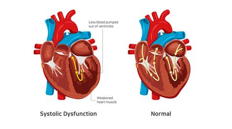 left ventricular systolic dysfunction causes.